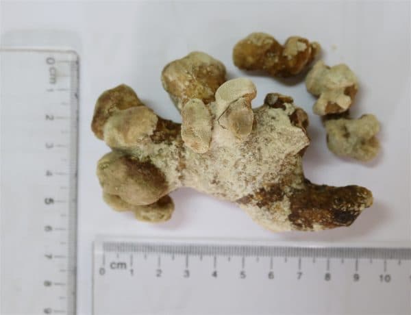 Sỏi san hô (sỏi có hình dạng như một đám san hô) thường lắng đọng theo hình dạng của bể thận (ảnh minh họa)