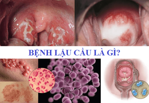 dấu hiệu bệnh lậu