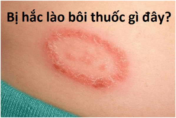 điều trị bệnh hắc lào