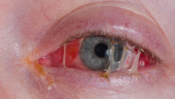 Gỉ mắt bất thường là gì?