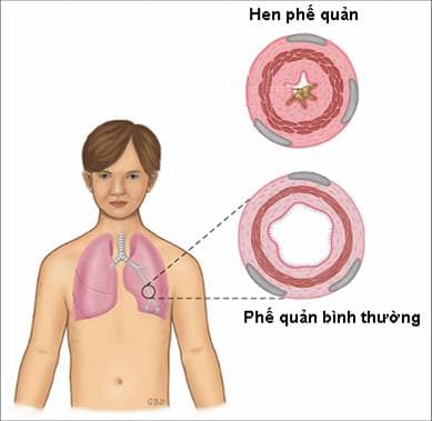 hen phế quản dễ gây suy hô hấp nếu không có biện pháp phòng tránh và xử trí kịp thời