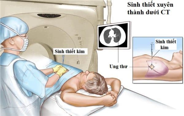 Kết quả sinh thiết có chính xác không còn phụ thuộc vào nhiều yếu tố