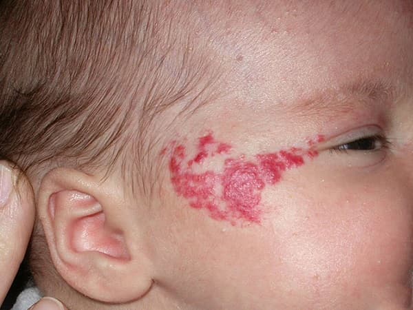 khám bướu máu ở trẻ em 