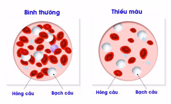 thể tích trung bình hồng cầu thấp