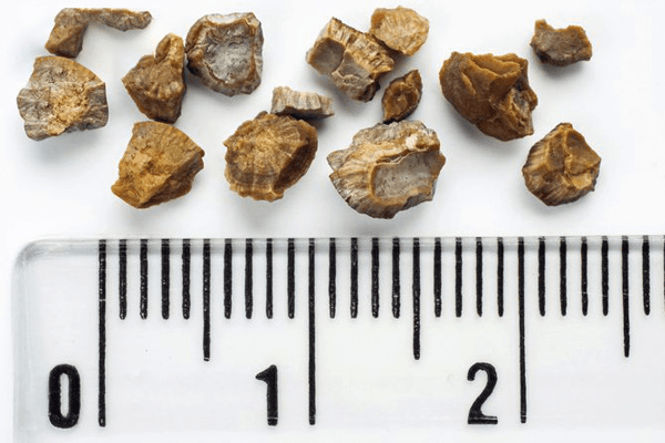 Trước đây, sỏi thận có kích thước quá lớn để có thể thoát ra ngoài hoặc đã mắc kẹt ở đường tiết niệu với chức năng thận kém bệnh nhân có thể được chỉ định mổ sỏi thận (ảnh minh họa)