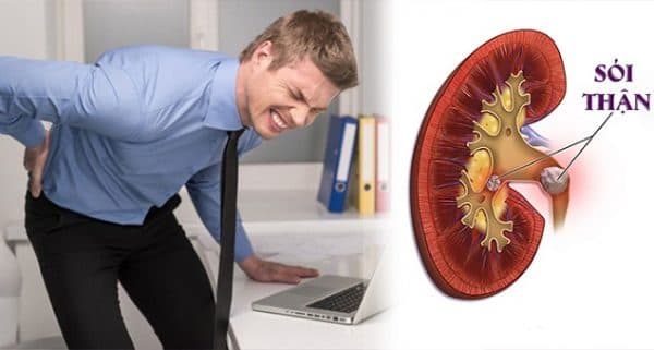 Yếu tố thuận lợi thúc đẩy hình thành sỏi ở nam giới