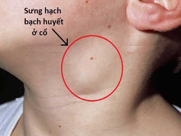sưng hạch bạch huyết ở cổ do bệnh gì? 