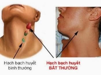 sưng hạch bạch huyết ở cổ 