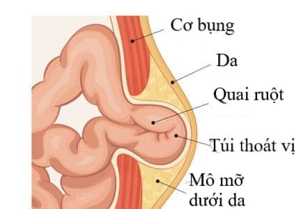 Thoát vị bẹn có thể gây hoại tử ruột, mạc treo ruột, gây viêm phúc mạc toàn thể, xoắn tinh hoàn ở nam giới.