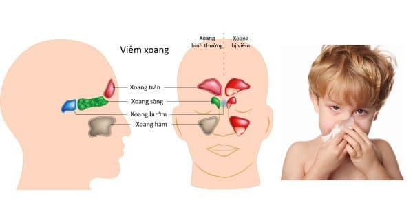 viêm xoang gây triệu chứng nghẹt mũi ở trẻ 