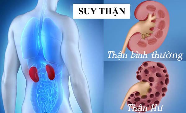 Nguyên nhân sỏi thận gây suy thận