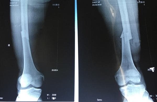 Gãy xương chày bao lâu thì lành? Phụ thuộc vào yếu tố nào?