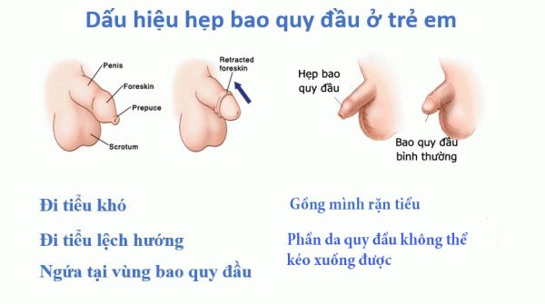 hẹp bao quy đầu ở trẻ em