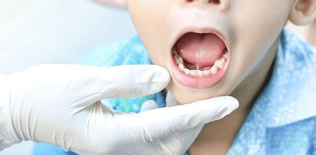 Cách chăm sóc trẻ sau phẫu thuật dính thắng lưỡi