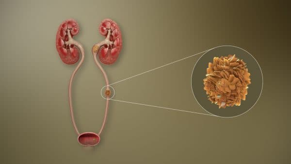 Nguyên nhân gây sỏi tiết niệu ở người trẻ tuổi