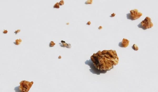 Nguyên nhân hình thánh sỏi thận canxi