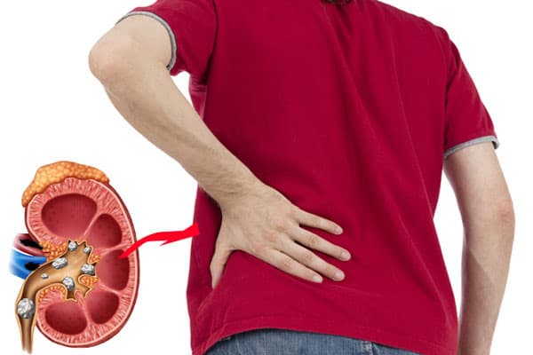 Những nguy hiểm từ sỏi thận lâu năm