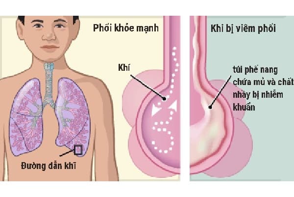 Bệnh viêm phổi ở trẻ em diễn biến nặng hơn ở người lớn