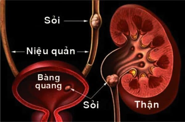 Tùy vào kích thước, vị trí có sỏi mà có các biện pháp và chi phí tán sỏi khác nhau (ảnh minh họa)
