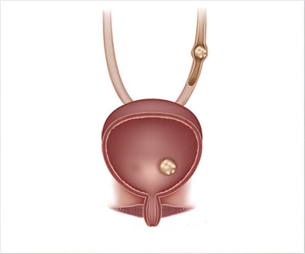 Sự hình thành sỏi bàng quang