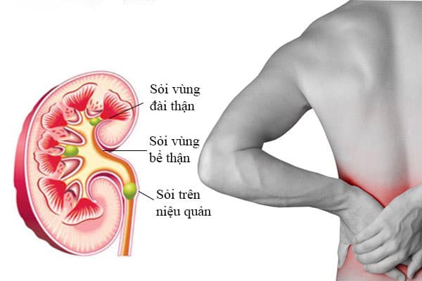 Tán sỏi qua da được chỉ định trong những trường hợp bệnh nhân có sỏi thận 2cm, sỏi niệu quản 1/3 trên và 1,5cm (ảnh minh họa)