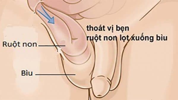 thoát vị bẹn ở trẻ em