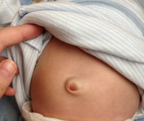 biểu hiện thoát vị rốn ở trẻ em