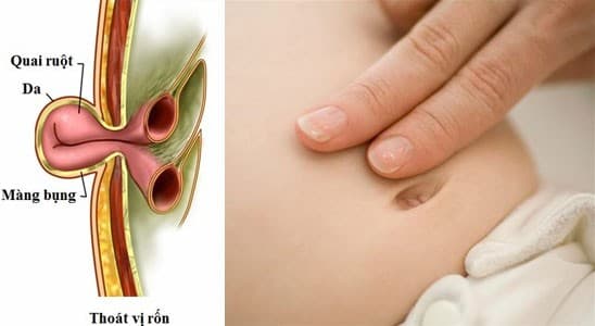 thoát vị rốn ở trẻ em là gì