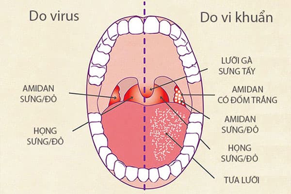 vì sao viêm họng gây khớp đớp tim