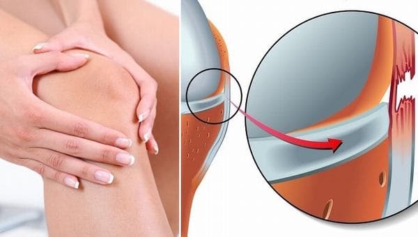 Đầu gối là vị trí thường bị chấn thương giãn dây chằng