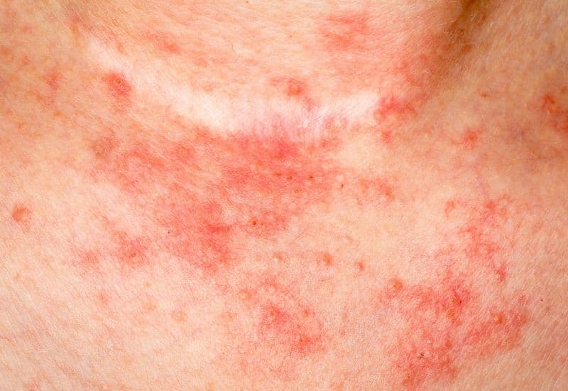 trẻ bị viêm da cơ địa 