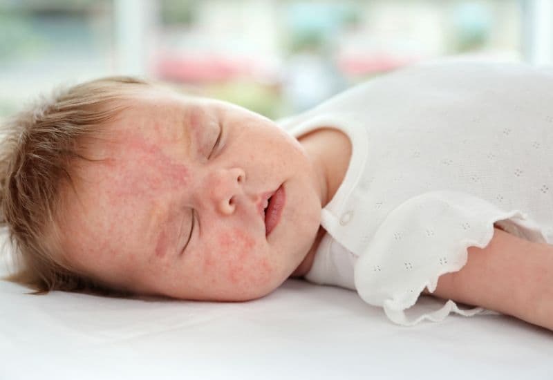 cơ địa dị ứng ở trẻ em