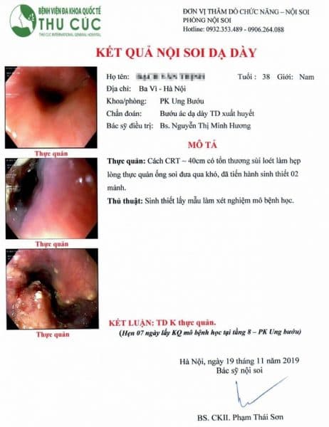 Hình ảnh nội soi phát hiện ung thư trong thực quản bệnh nhân B.V.T