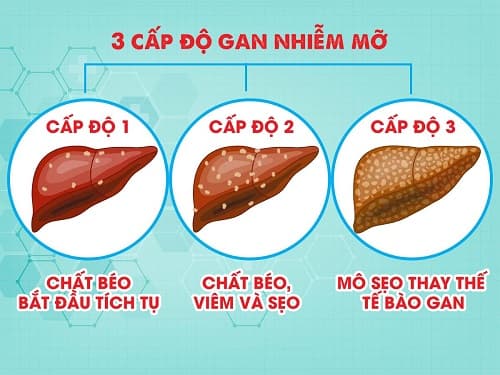 Các cấp độ của bệnh gan nhiễm mỡ