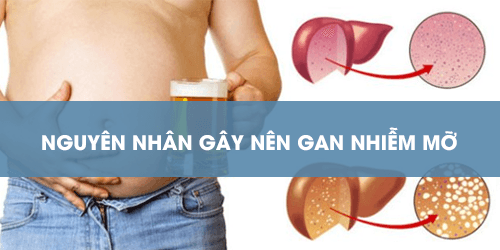 Nguyên nhân gây bệnh gan nhiễm mỡ