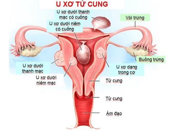 u xơ tử cung 