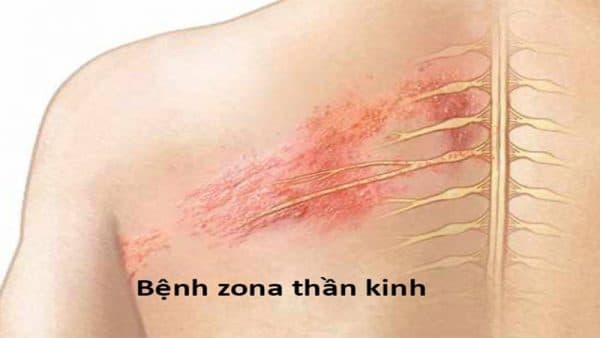 nguyên nhân gây zona thần kinh ở trẻ em