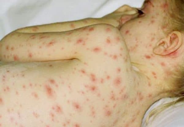 Bệnh thủy đậu ở trẻ