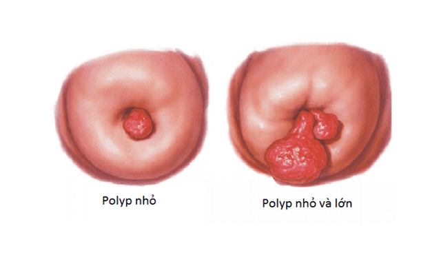 Polyp cổ tử cung: Nguyên nhân, triệu chứng và điều trị