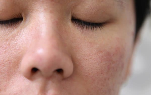 Rất nhiều người bị viêm lỗ chân lông ở mặt