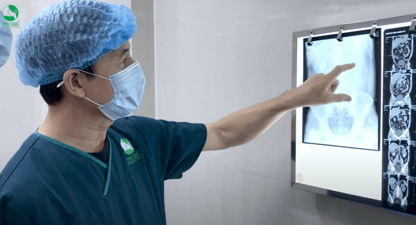 Bệnh viện ĐKQT Thu Cúc tán thành công ca sỏi có kích thước 7cm