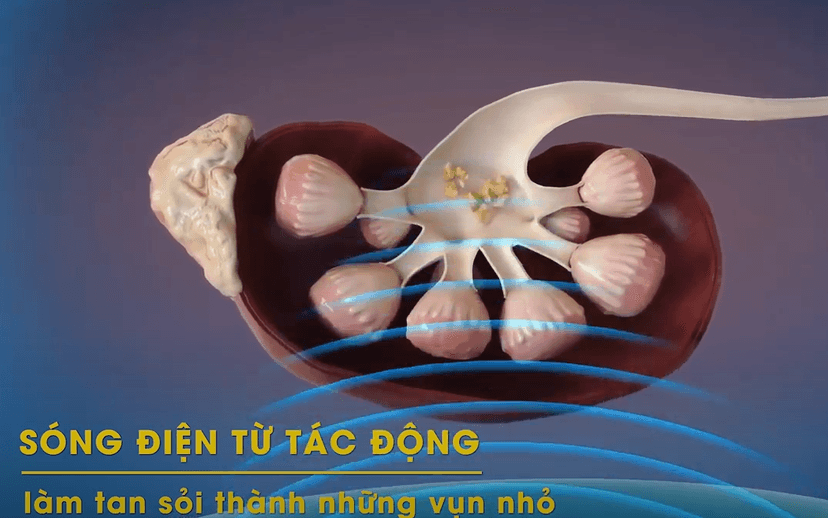 Dịch vụ tán sỏi ngoài cơ thể tại bệnh viện Thu Cúc