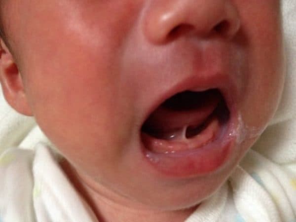 Mẹ có thể dựa vào một số dấu hiệu bất thường ở lưỡi để nhận biết dấu hiệu về bệnh lý dính thắng lưỡi