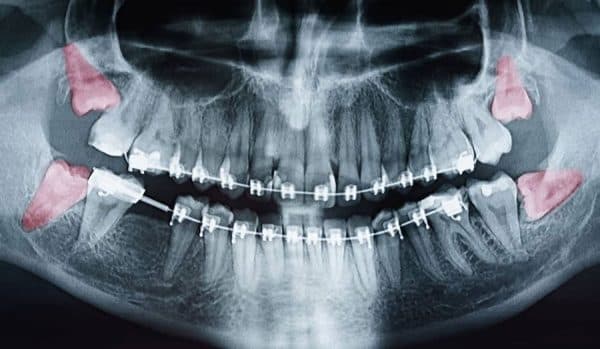 có nên nhổ răng khôn không?