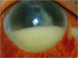 viêm nội nhãn ở trẻ em