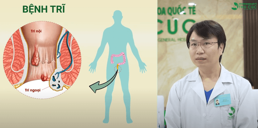 Bác sĩ giải đáp: Bệnh trĩ có tự khỏi được không?