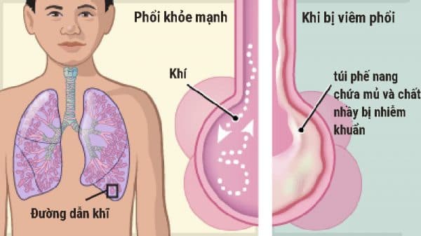Xử trí hiệu quả để ngăn ngừa các biến chứng viêm phổi ở trẻ em