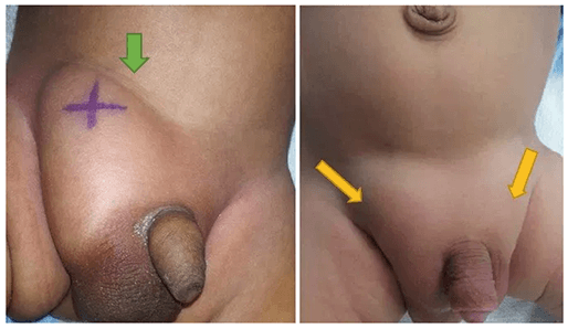 thoát vị bẹn bệnh thường gặp ở bé trai