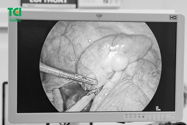 Ứng dụng công nghệ cao: Phẫu thuật ít đau, ít xâm lấn, phục hồi nhanh
