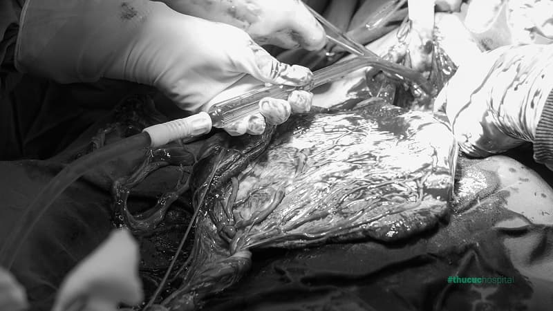 Dây rốn bám mép là sự bất thường ở dây rốn, thay vì bám vào trung tâm bánh rau thì lại bám vào mép bánh rau, gây ảnh hưởng tới việc hấp thu dinh dưỡng của thai nhi.